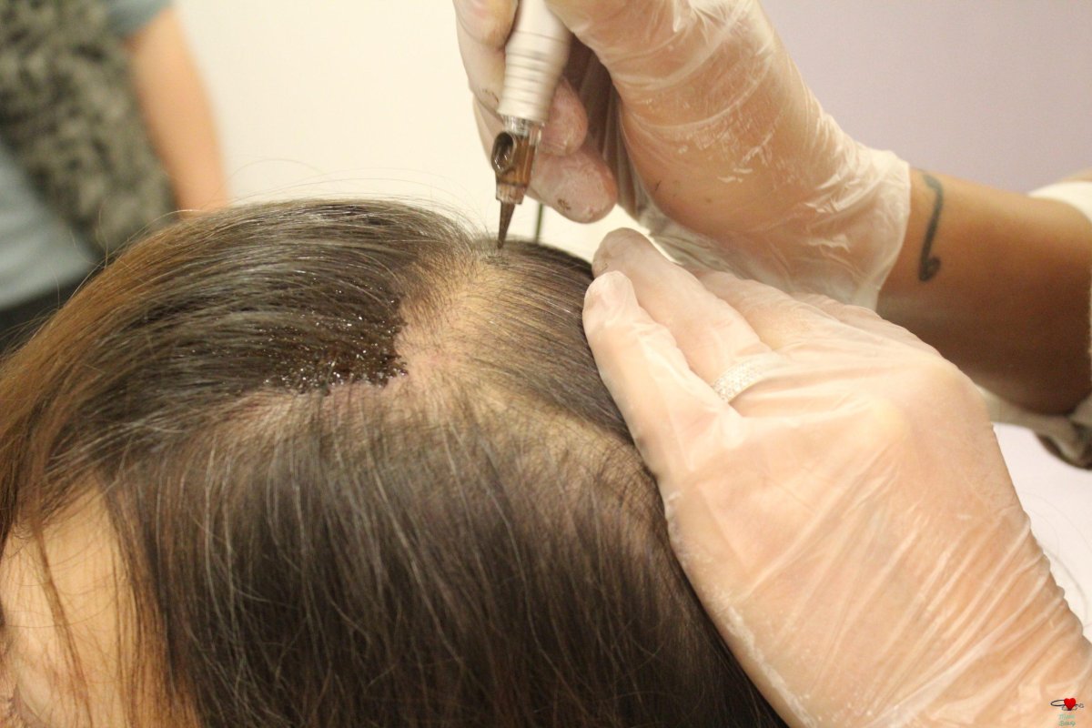 أفضل مراكز زراعة الشعر في دبي