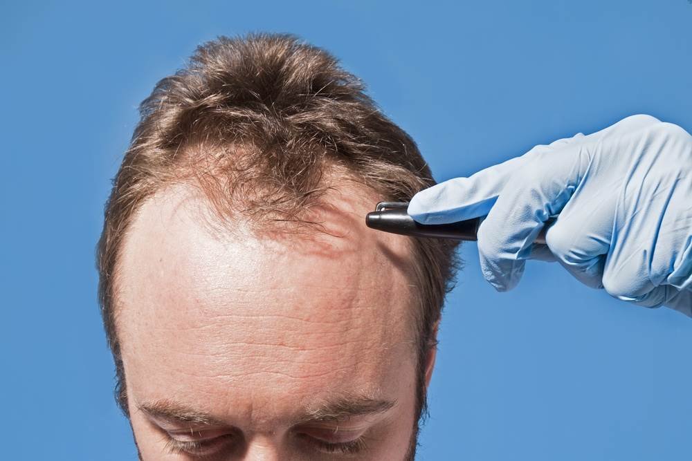 أفضل مراكز زراعة الشعر في أبوظبي