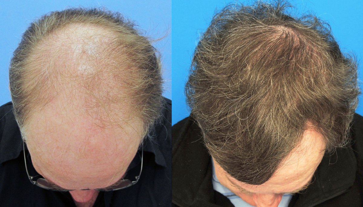 أفضل مراكز زراعة الشعر في الشارقة