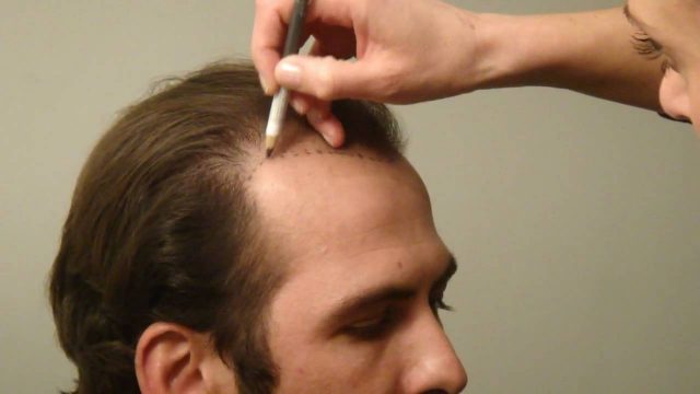 أفضل مراكز زراعة الشعر في أبوظبي