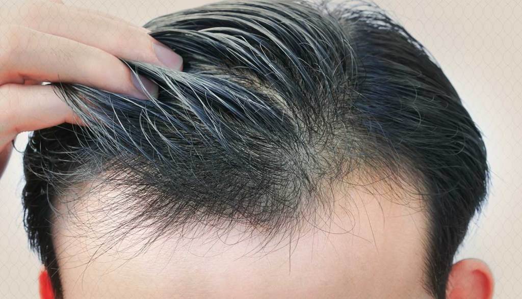 أفضل مراكز زراعة الشعر في دبي